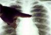 Cazuri noi de tuberculoză în Maramureș