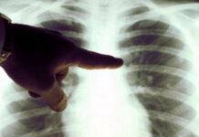 Cazuri noi de tuberculoză în Maramureș